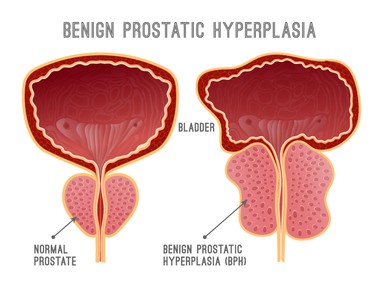 Benign Prostatic Hyperplasia Graphic