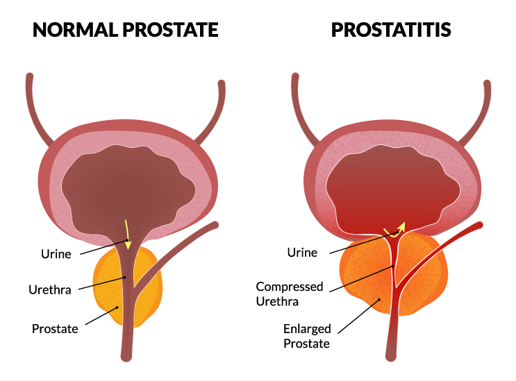Normal Prostate Vs Prostatitis Graphic