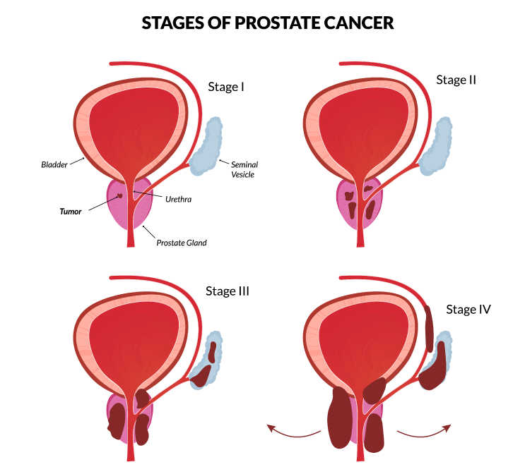 Stages Of Prostate Cancer