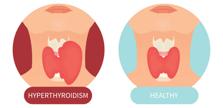 Hyperthyroidism Vs Healthy Thyroid