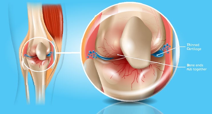 Diagram Of Osteoarthritis
