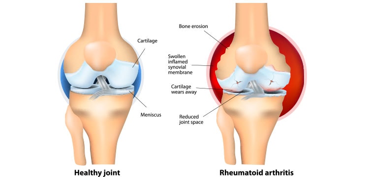 Diagram Of Rheumatoid Arthritis