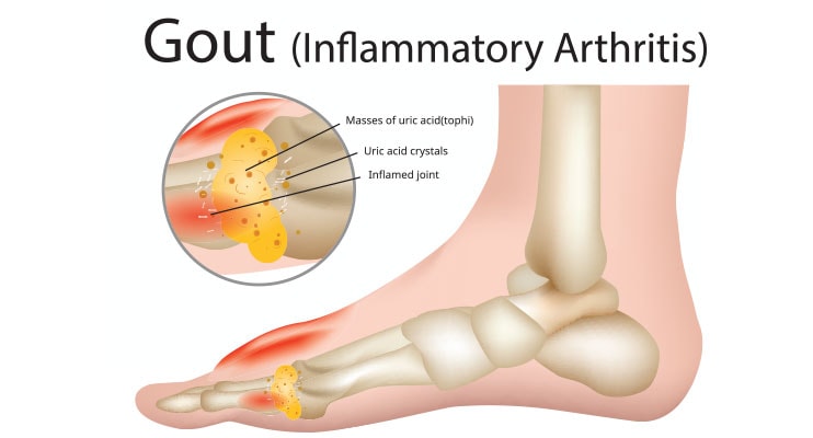 Diagram Of Gout Arthritis