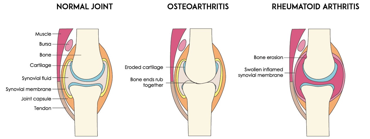 Diagram Of Normal Joint Versus Joint With Arthritis