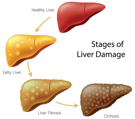 Diagram Of The Stages Of Liver Disease