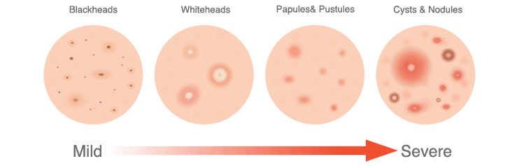 Severity Levels Of Acne