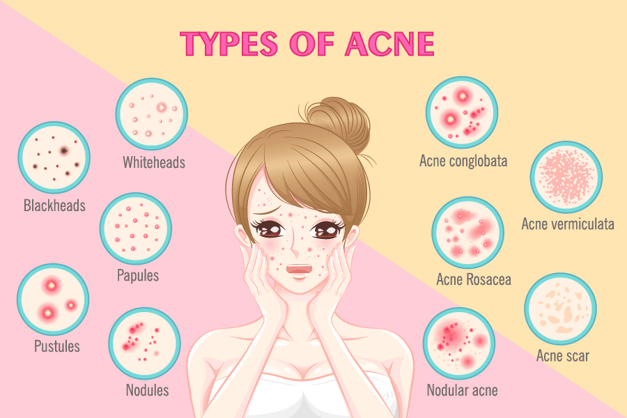 Types Of Acne