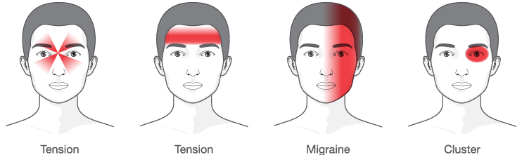 Diagram Of The Different Types Of Headaches