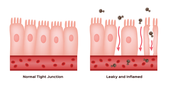 Symptoms Of Leaky Gut